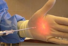 لیزر هموروئید؛ درمانی قطعی و فوری