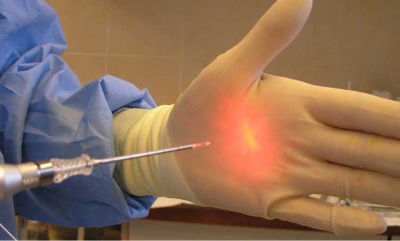 لیزر هموروئید؛ درمانی قطعی و فوری