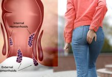 درمان قطعی بواسیر با لیزر؛ پایان دردهای همیشگی در بیماری های نشیمنگاهی