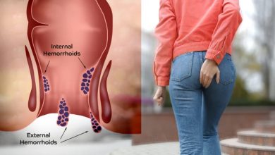 درمان قطعی بواسیر با لیزر؛ پایان دردهای همیشگی در بیماری های نشیمنگاهی