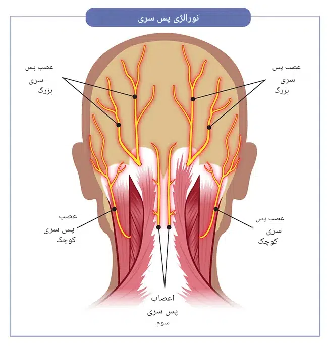 اکسیپیتال نورالژی