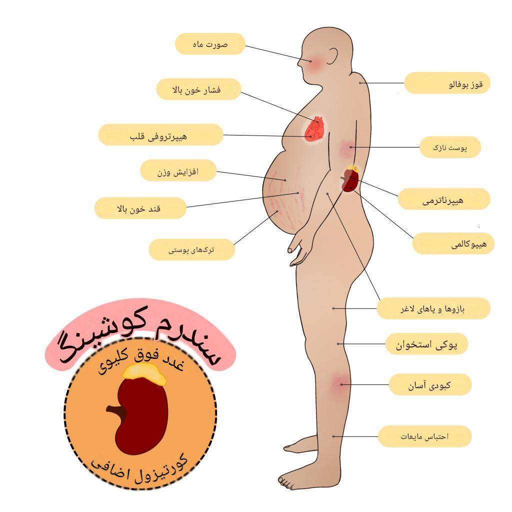 اما کورتیزول بالا چه علائمی دارد؟