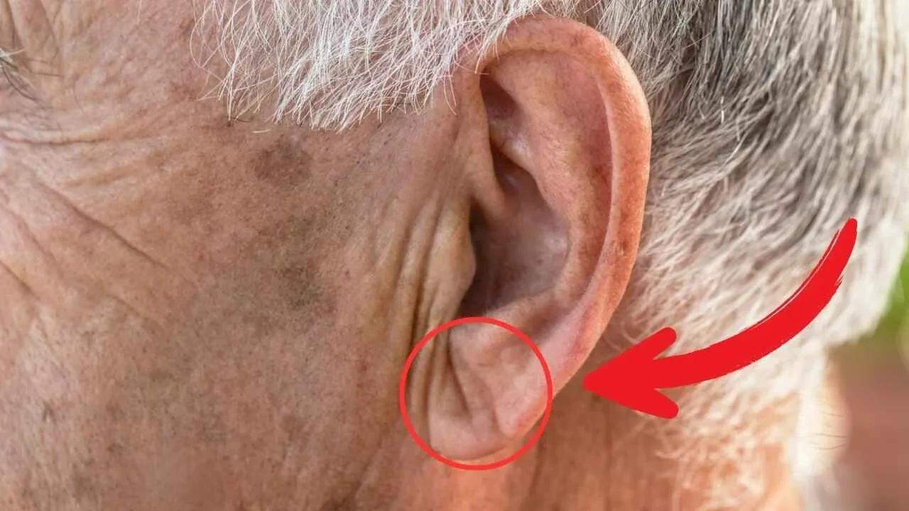 ۱. ایجاد چین مشخص روی لاله گوش