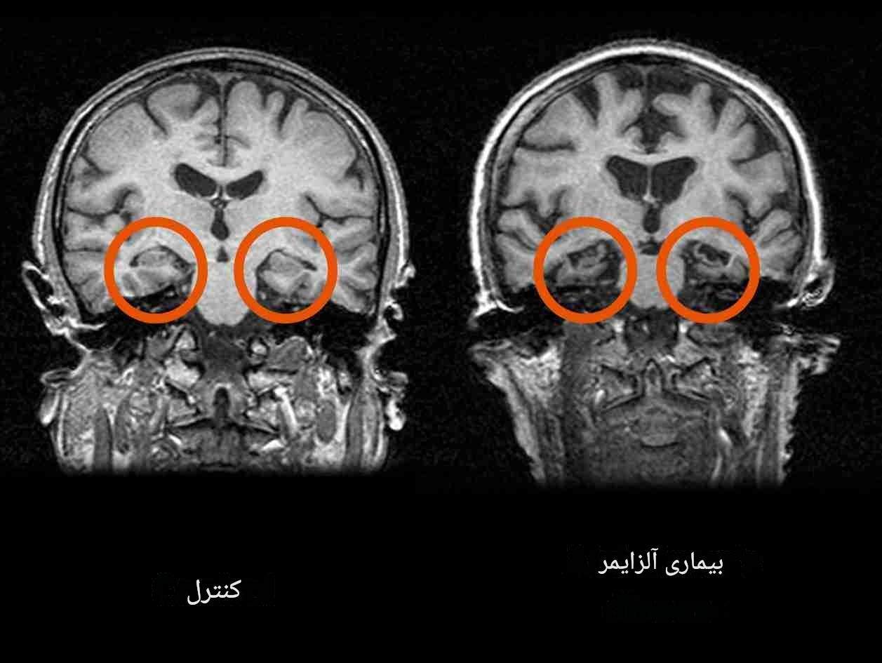 آیا خوردن زیاد قند در کودکی باعث زوال عقل میشود؟