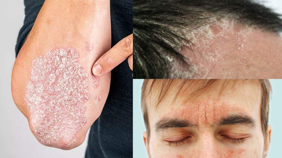 پسوریازیس چه علائمی دارد؟
