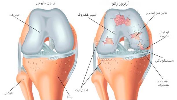 آرتروز چیست و چرا درمان آن دشوار است؟